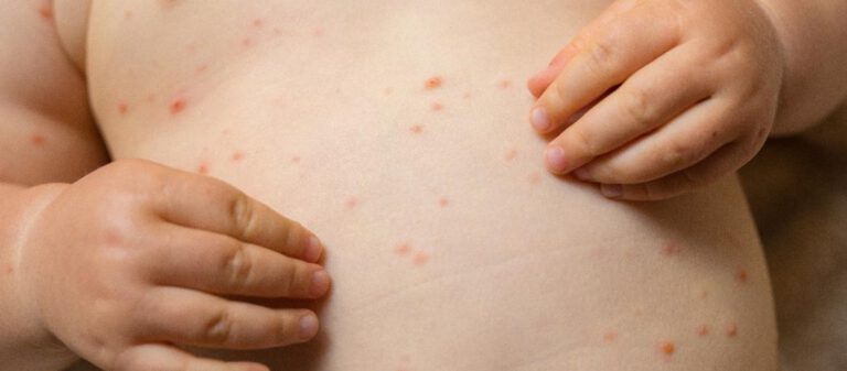 Sesapi alerta para a importância da vacina contra Sarampo