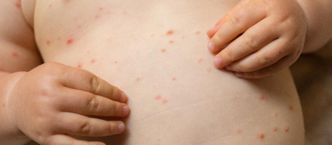 Sesapi alerta para a importância da vacina contra Sarampo
