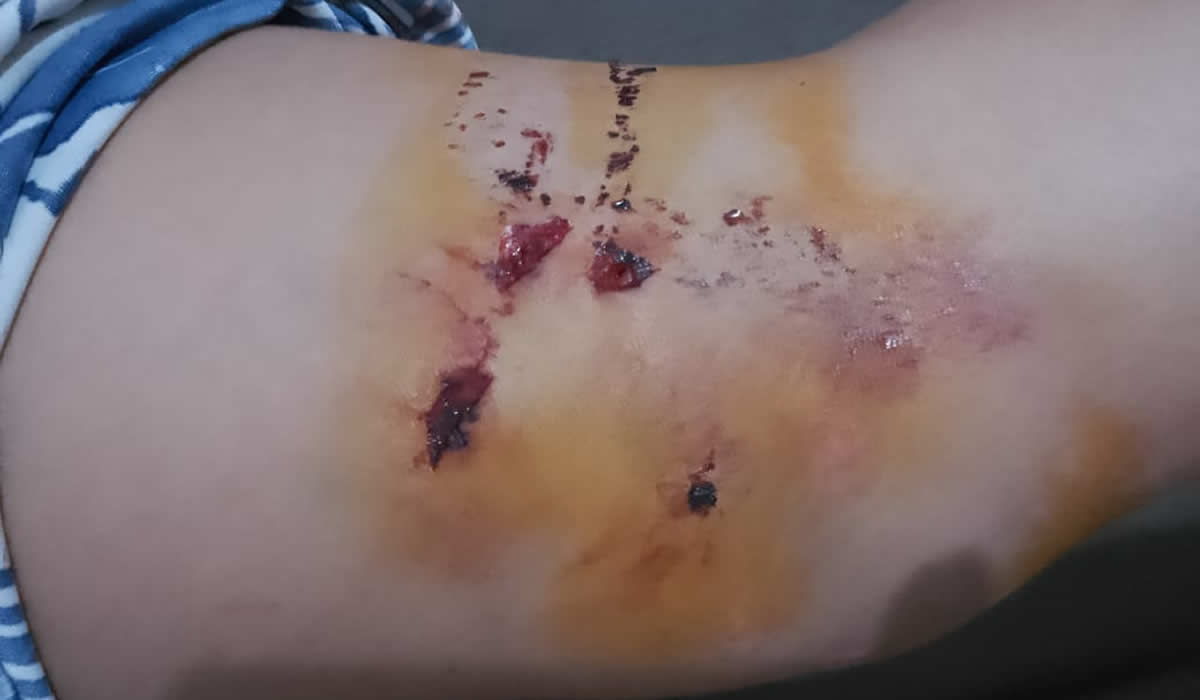 Criança é atacada por cinco cachorros no Centro de Picos