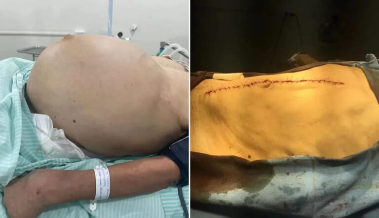 Idosa tem tumores de 11 kg retirados do abdômen