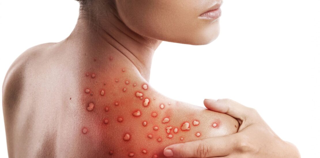 Vacinação contra Monkeypox será iniciada em Picos na próxima semana