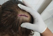 Vítima que sofreu golpe de picareta na cabeça – Foto: PMPI