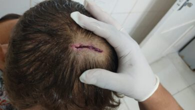 Vítima que sofreu golpe de picareta na cabeça – Foto: PMPI